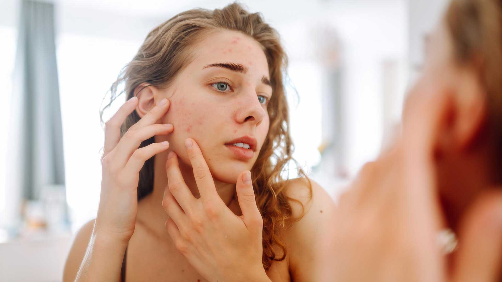 Personalised Self-Hypnosis – Skin Picking (Dermatillomania)